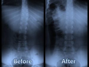 Child's_scoliosis_before_and_after_chiropractic