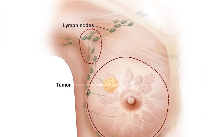 Breast Cancer Surgery Illustration